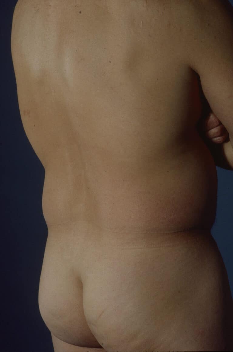 Before Image: Liposuction - right-back-oblique