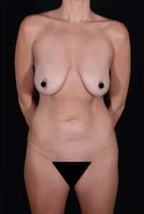 Before Image: Mommy Makeover